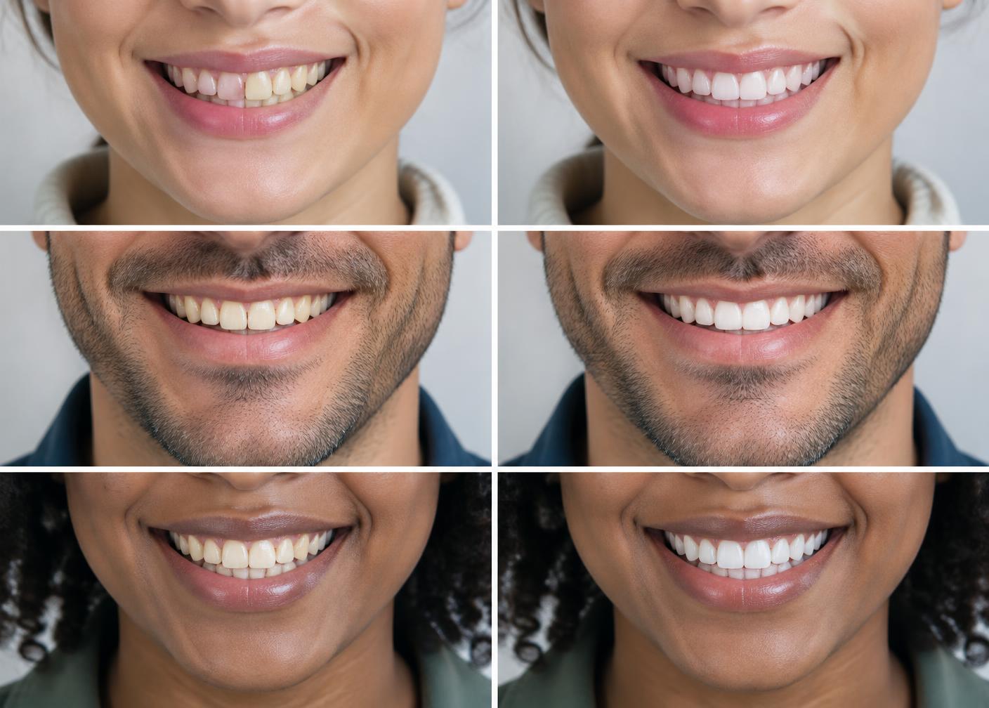 Three smile transformations showing before and after results